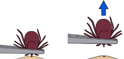 removal-ab.jpg#asset:6966